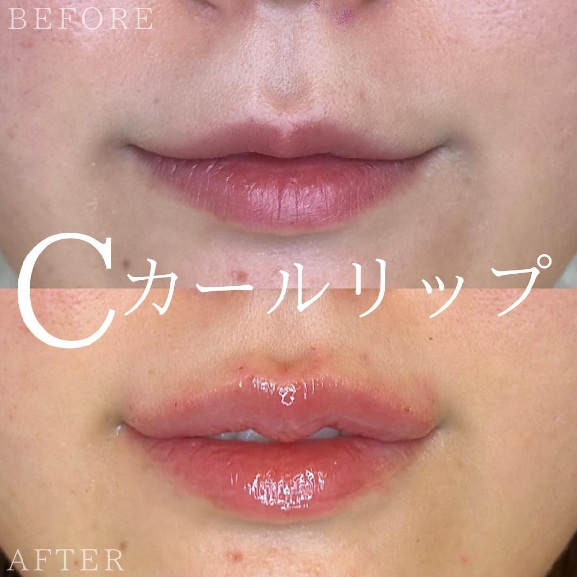 Cカールリップの症例写真
