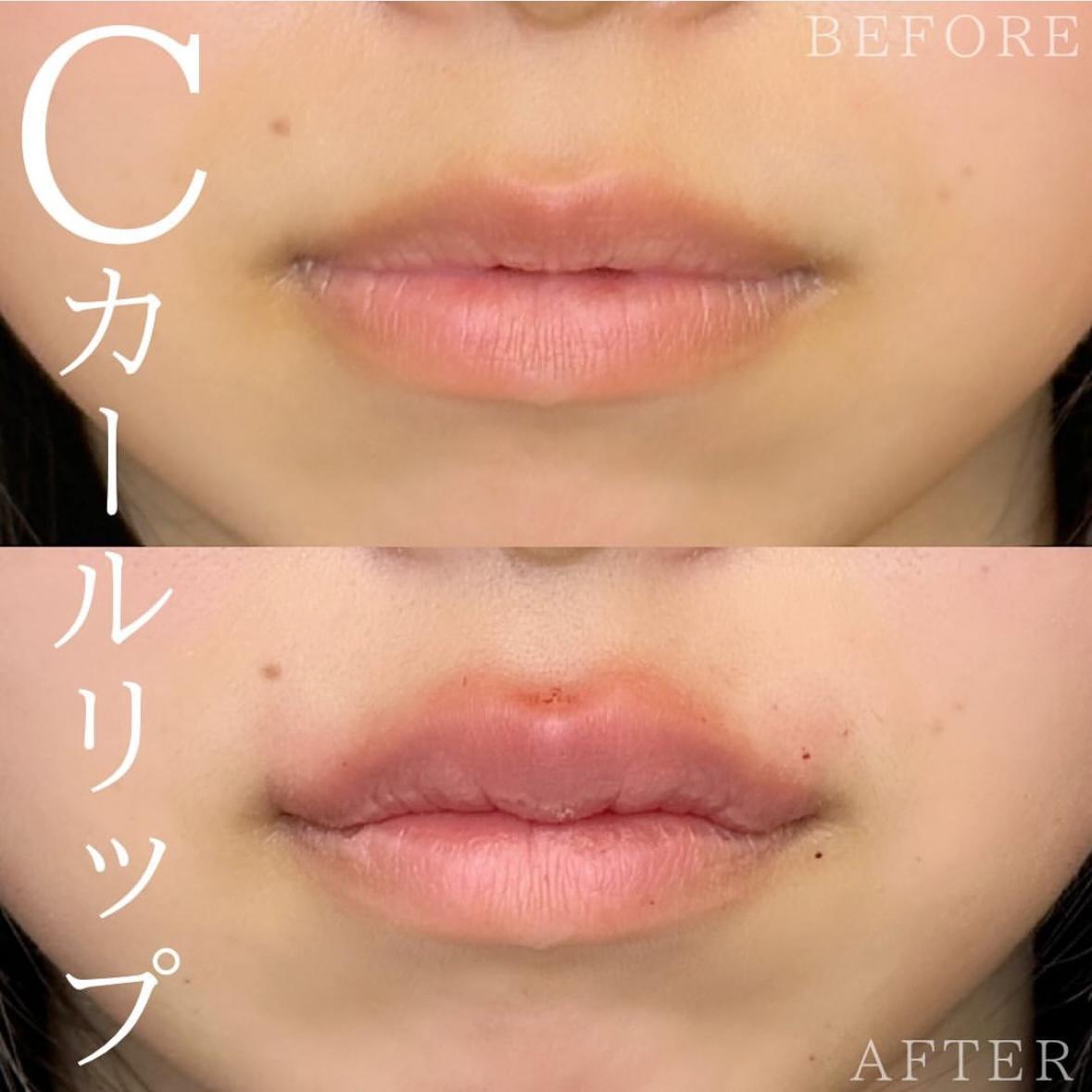 Cカールリップの症例写真
