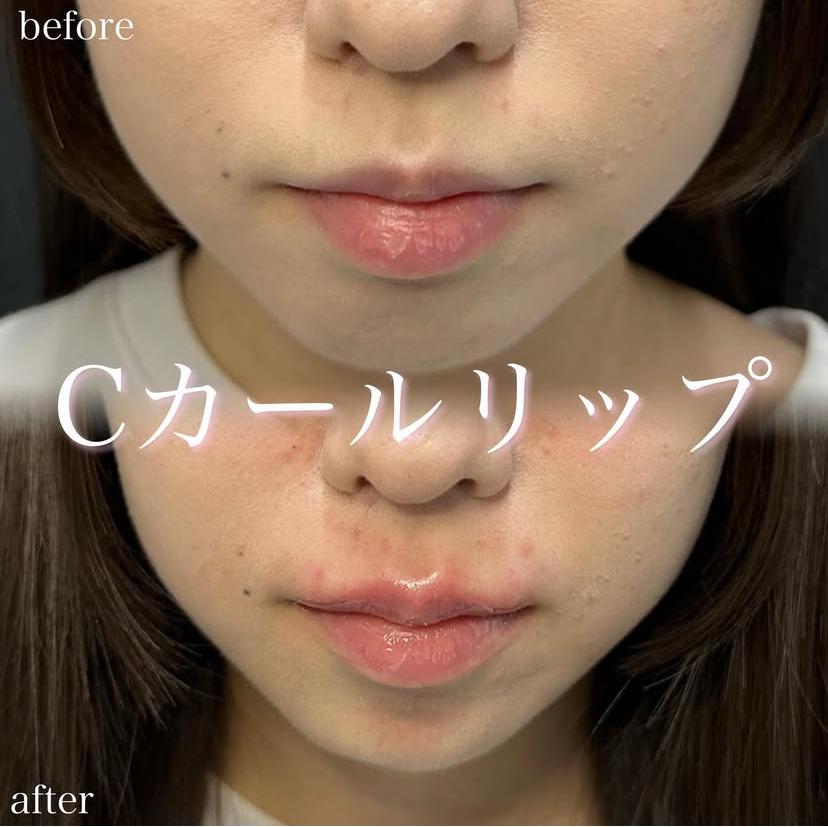Cカールリップの症例写真