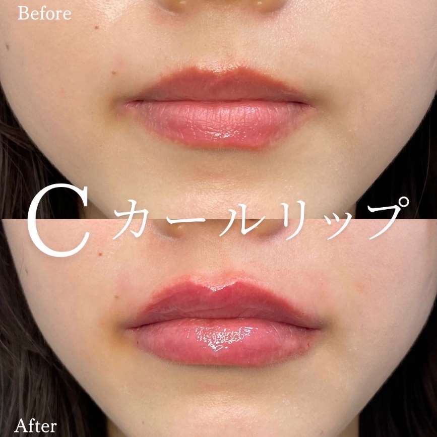Cカールリップの症例写真
