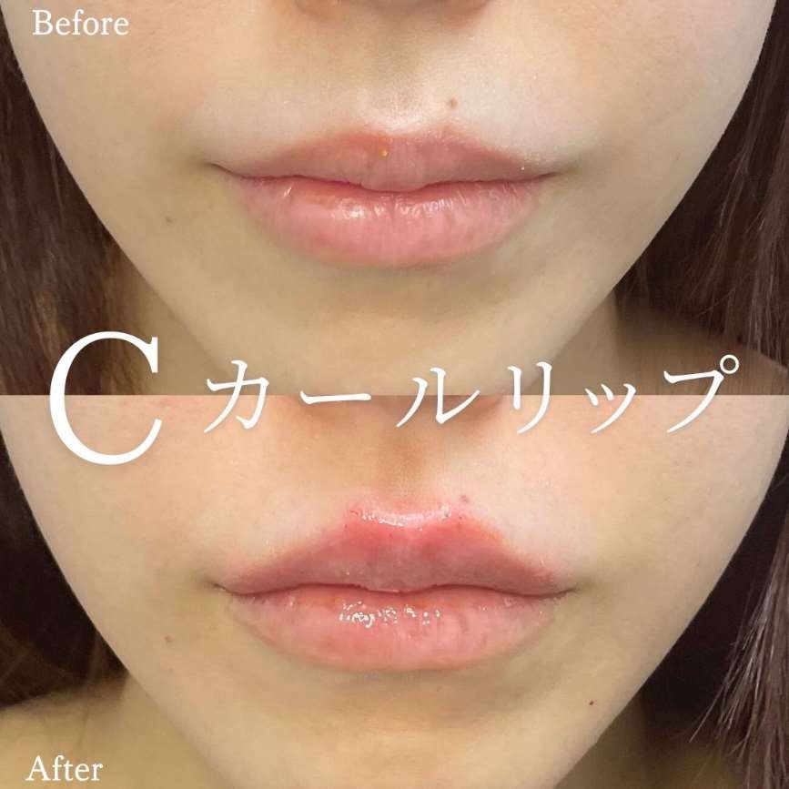 Cカールリップの症例写真