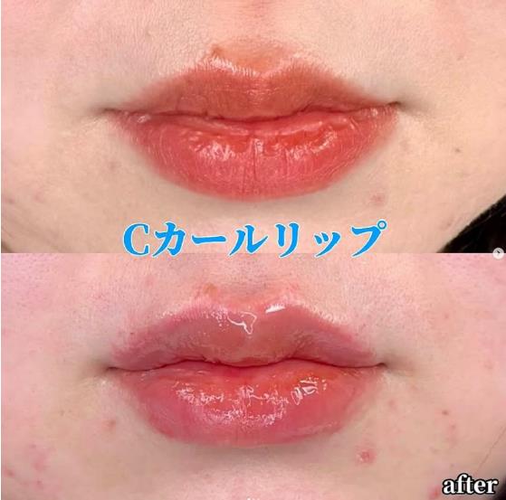 Cカールリップの症例写真
