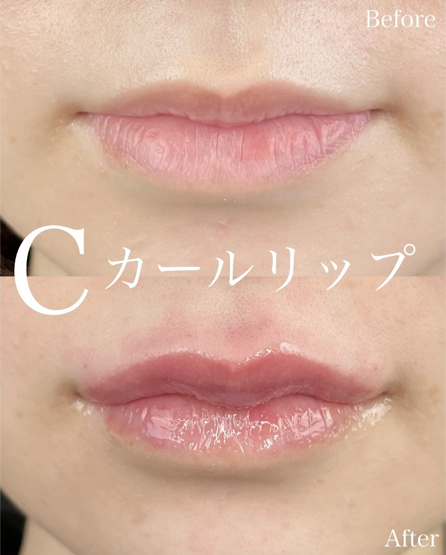 Cカールリップの症例写真