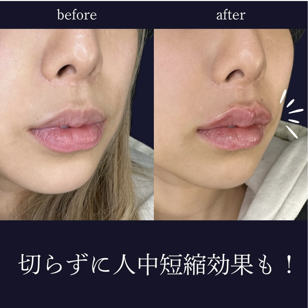 Cカールリップの症例写真