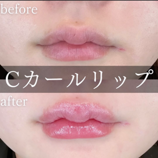Cカールリップの症例写真