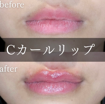 Cカールリップの症例写真