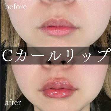 Cカールリップの症例写真