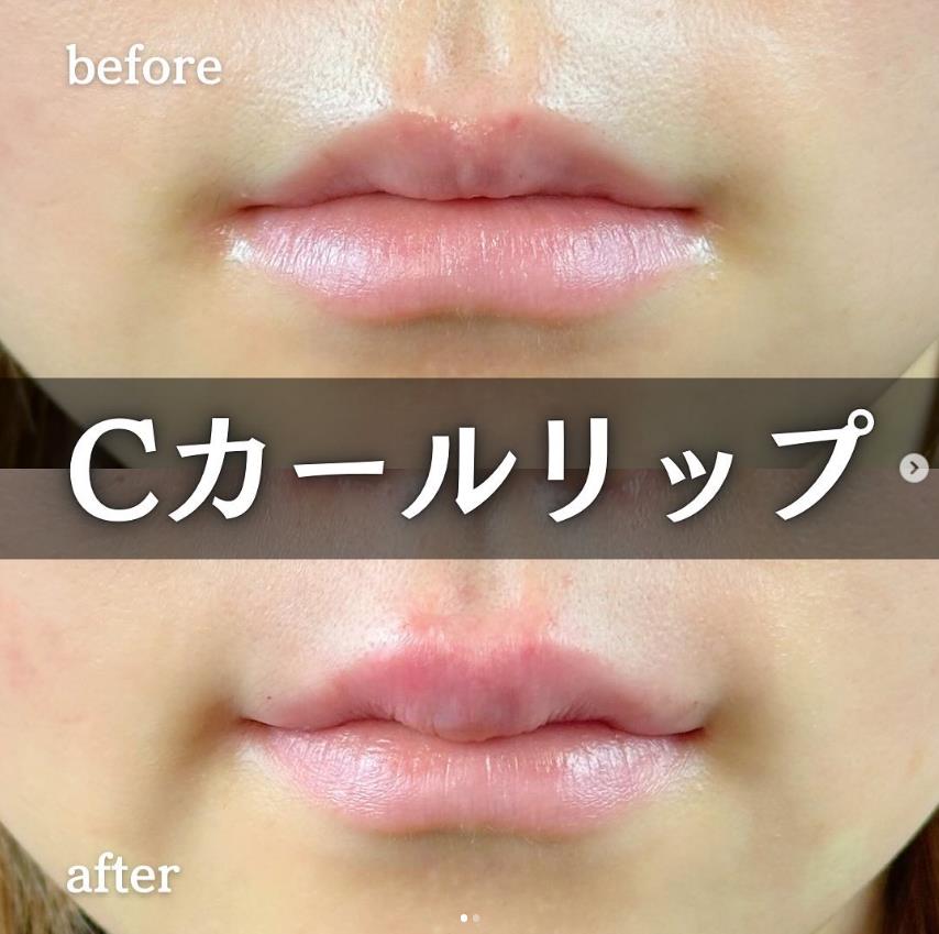 Cカールリップの症例写真
