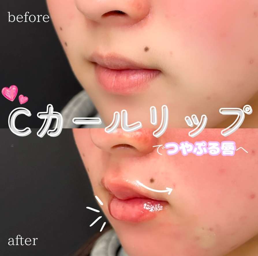Cカールリップの症例写真