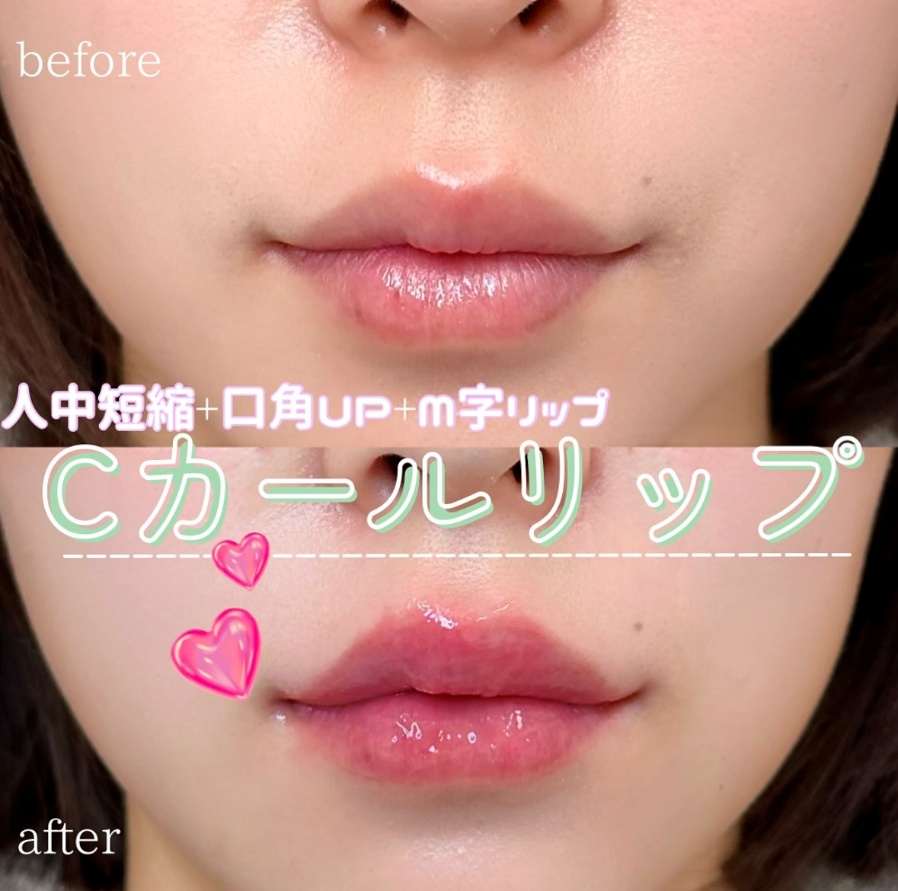 Cカールリップの症例写真