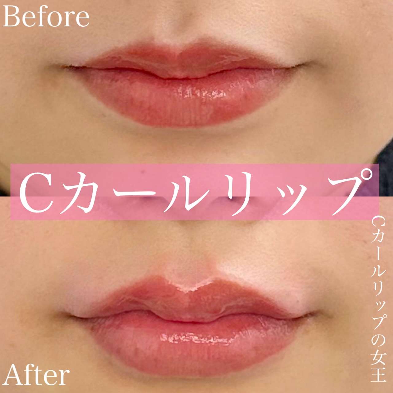 Cカールリップの症例写真