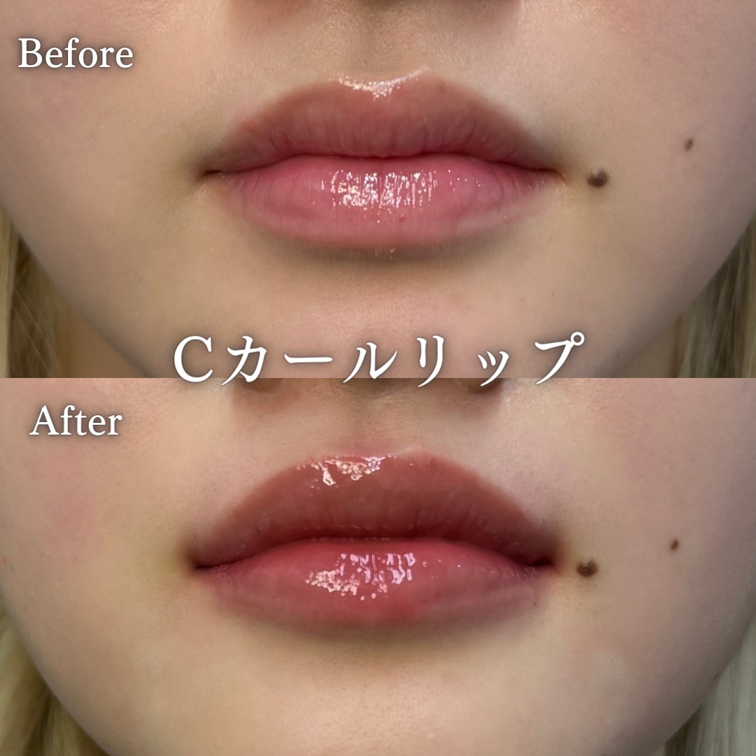Cカールリップの症例写真