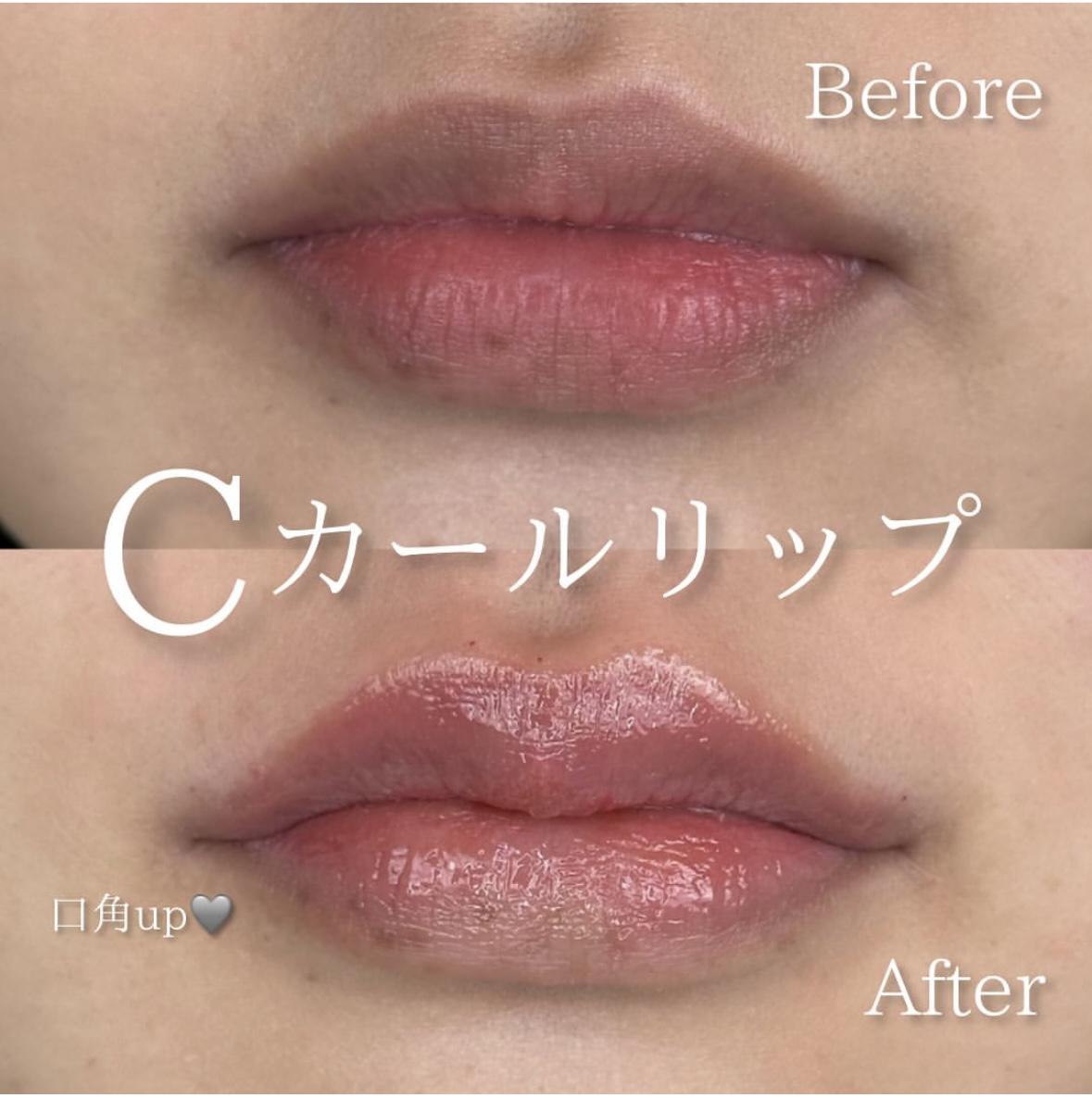 Cカールリップの症例写真