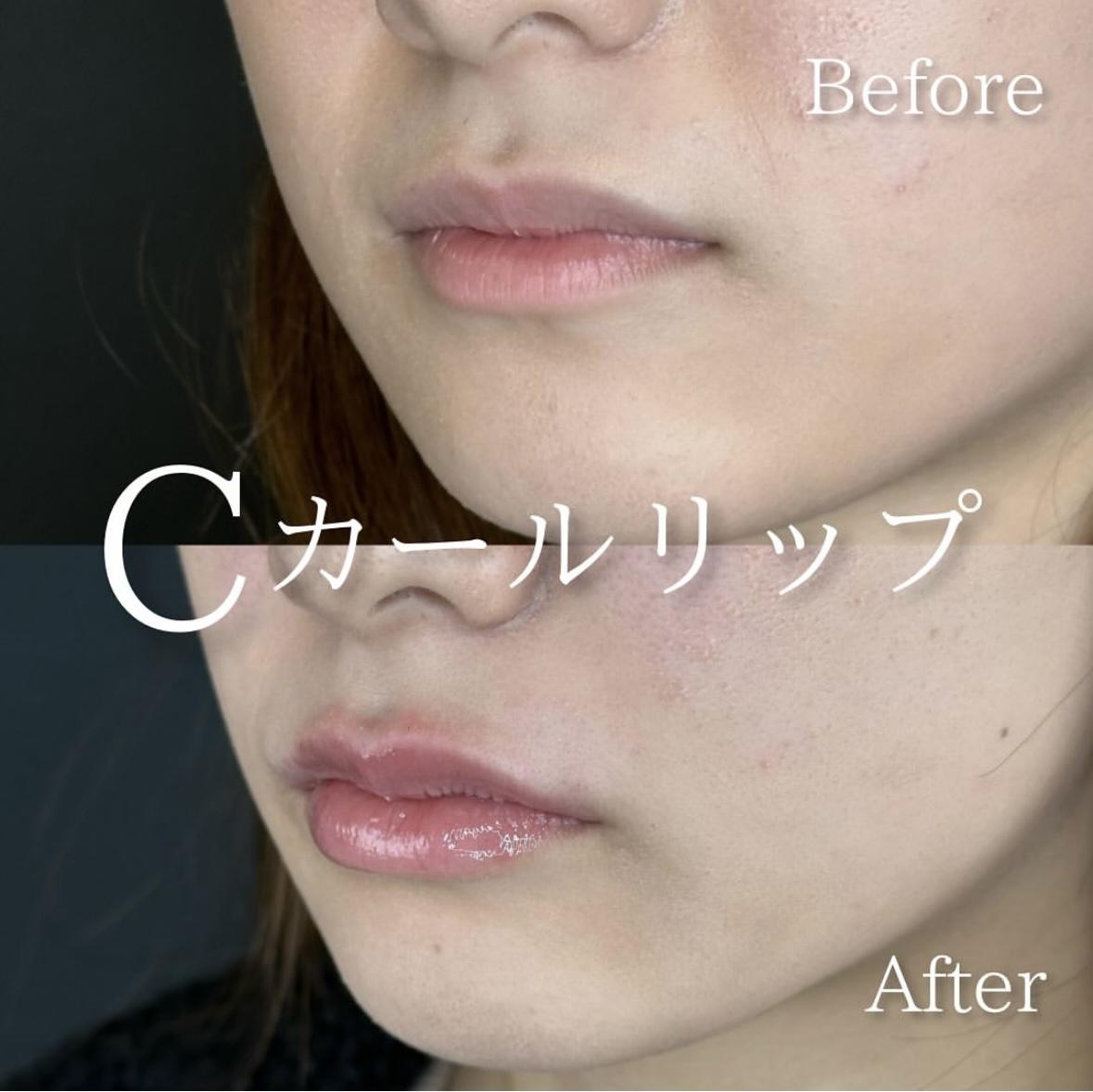 Cカールリップの症例写真