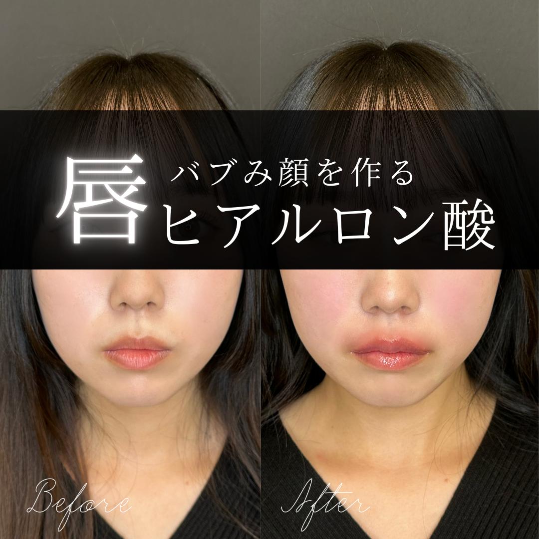 Cカールリップの症例写真