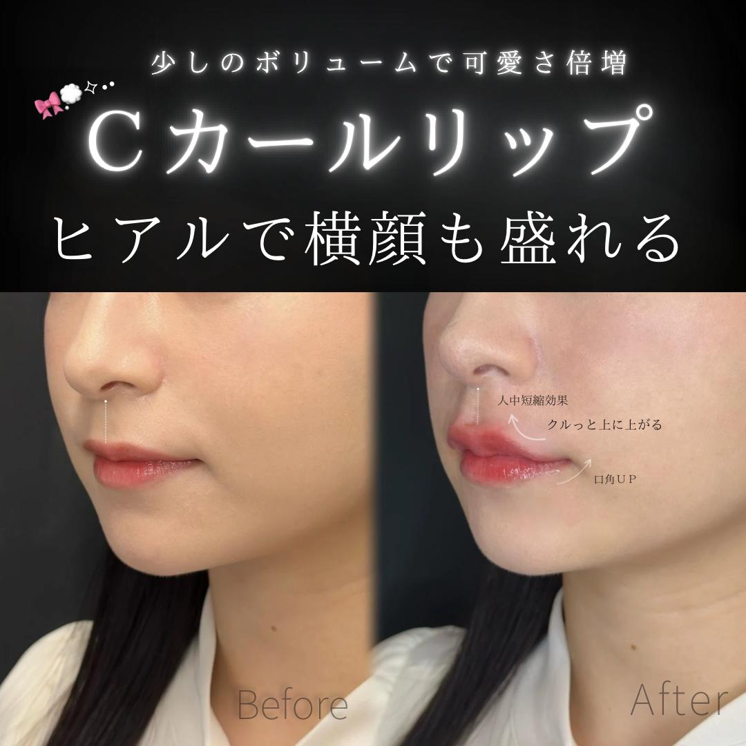 Cカールリップの症例写真