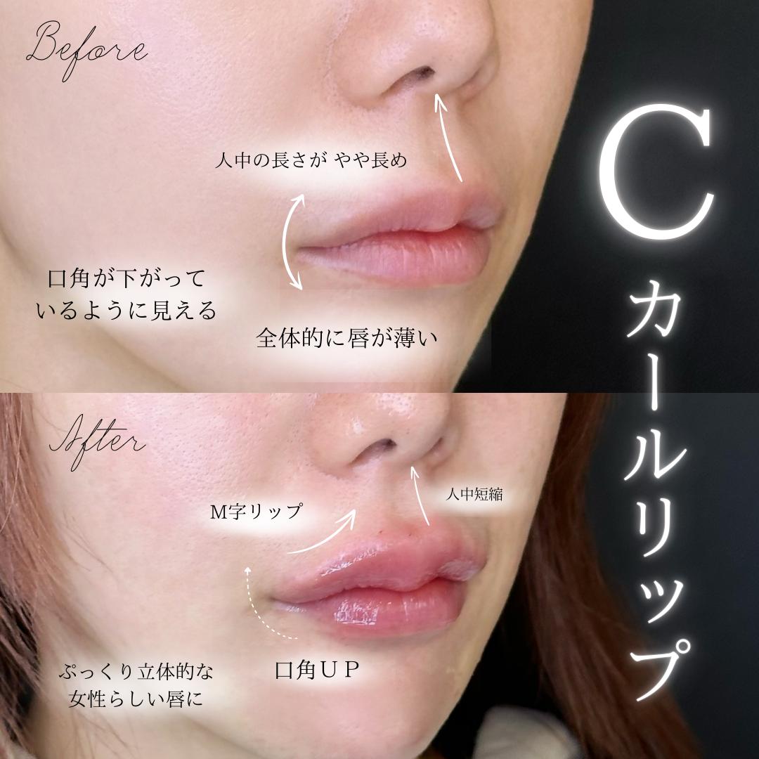 Cカールリップの症例写真