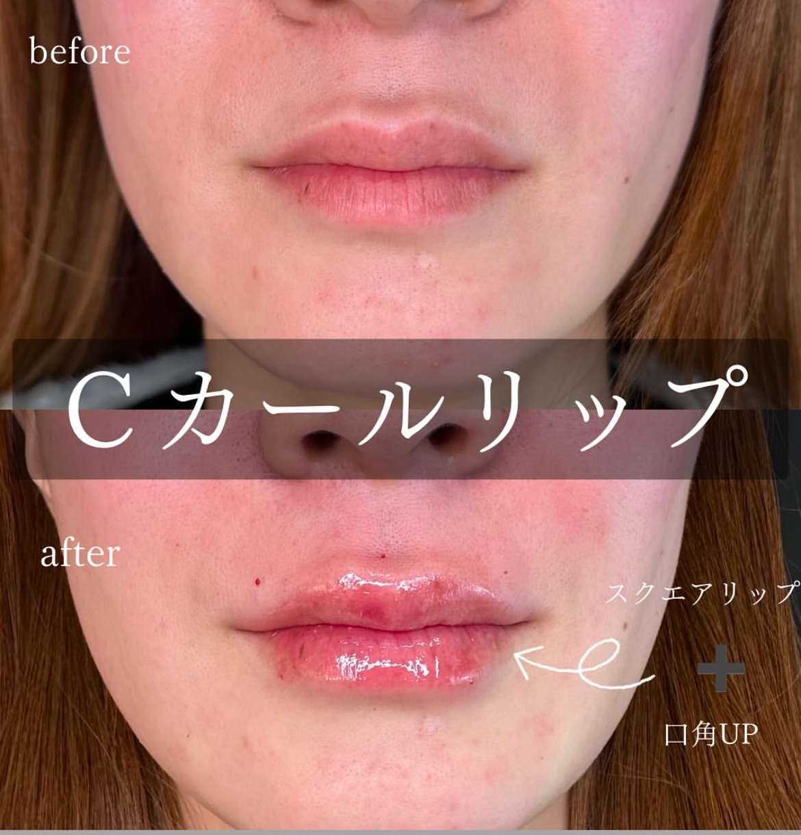 Cカールリップの症例写真