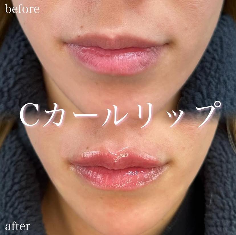 Cカールリップの症例写真