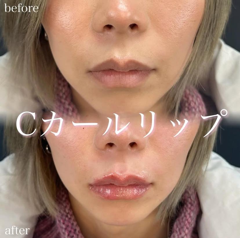 Cカールリップの症例写真