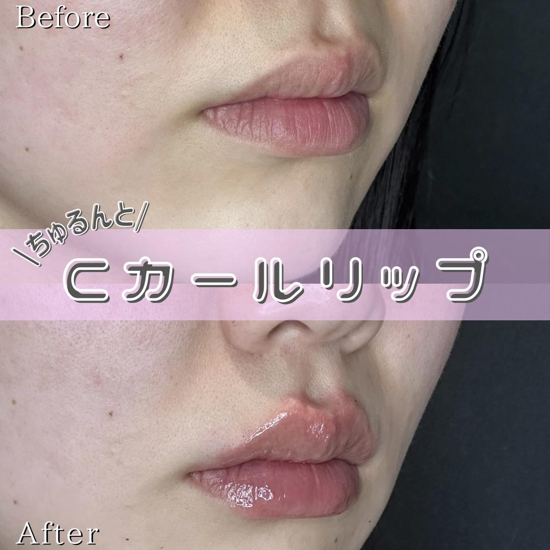Cカールリップの症例写真