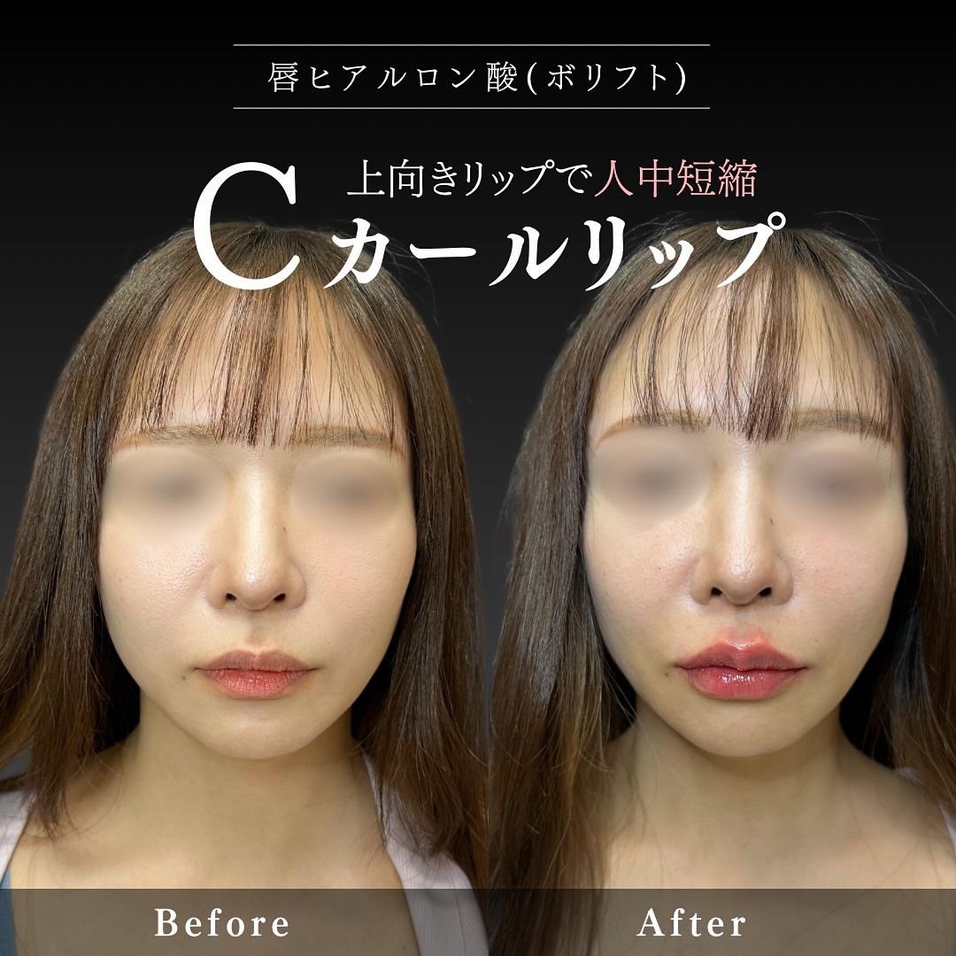 Cカールリップの症例写真
