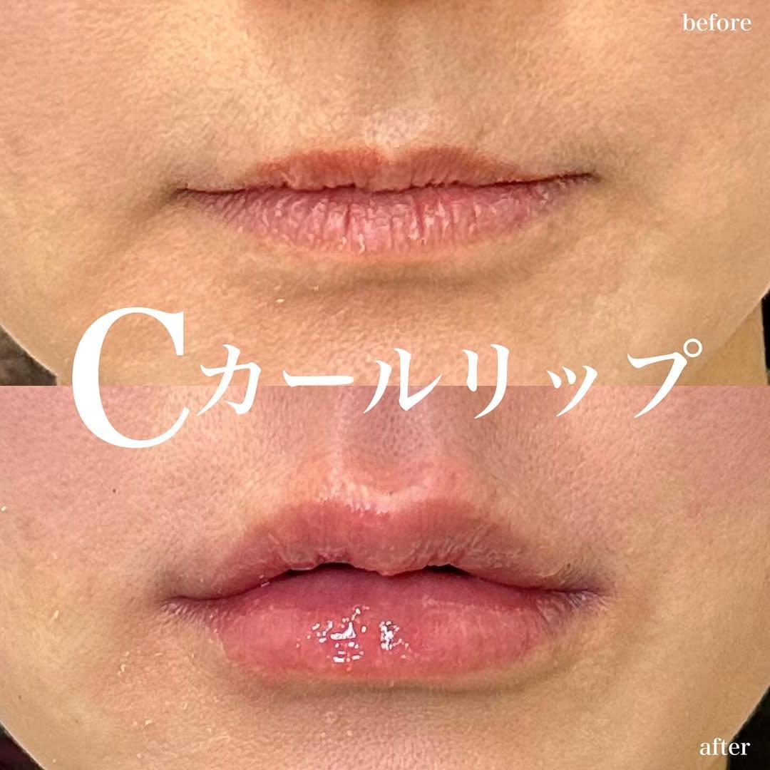 Cカールリップの症例写真