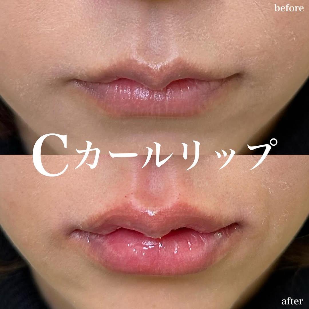 Cカールリップの症例写真