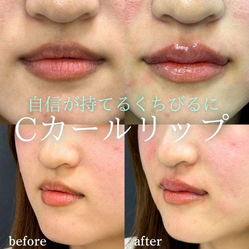Cカールリップの症例写真