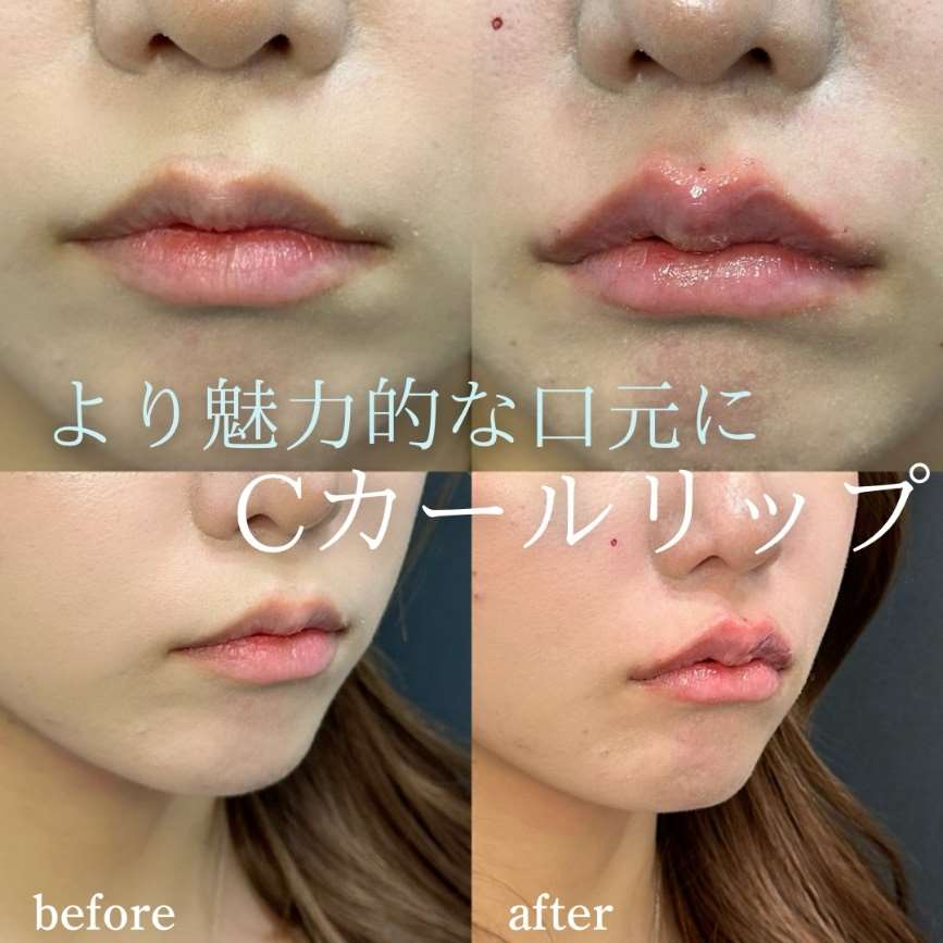 Cカールリップの症例写真