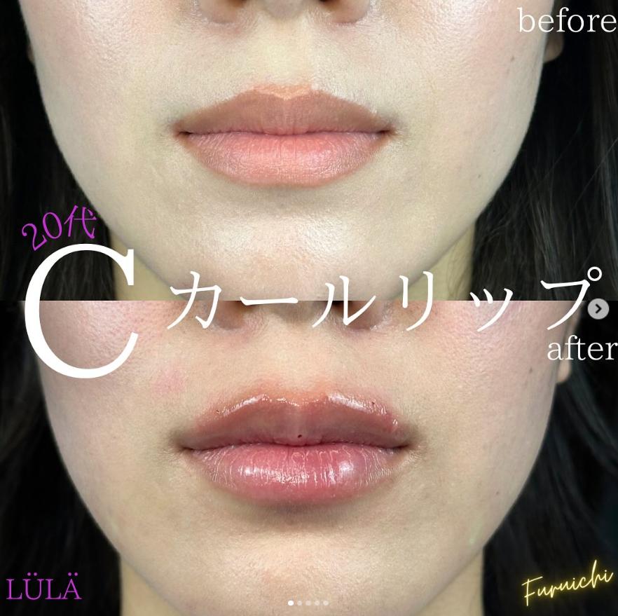 Cカールリップの症例写真