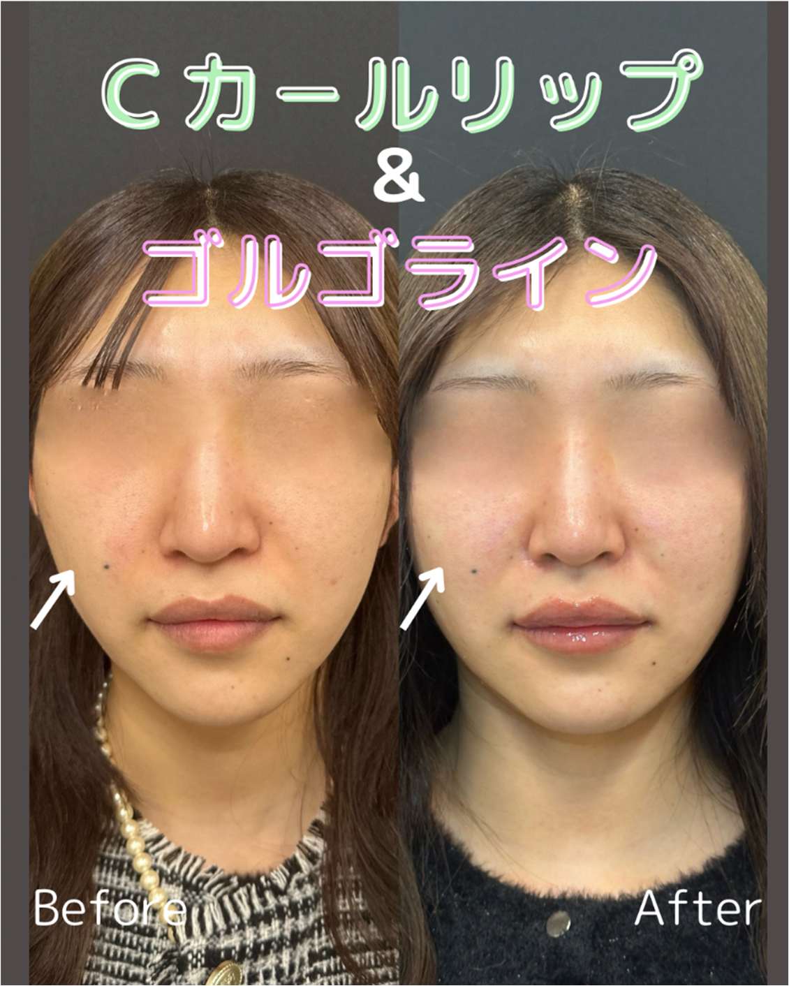 Cカールリップの症例写真