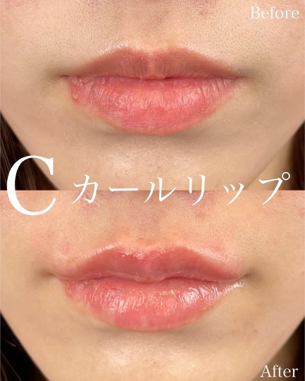 Cカールリップの症例写真