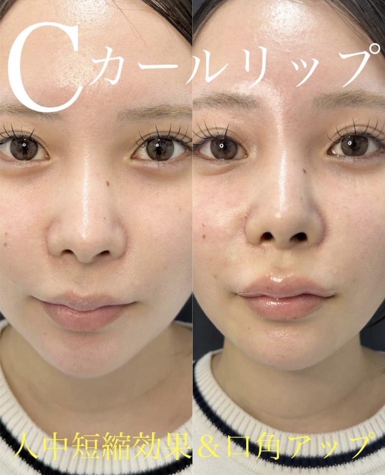 Cカールリップの症例写真