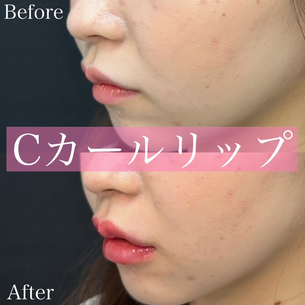 Cカールリップの症例写真