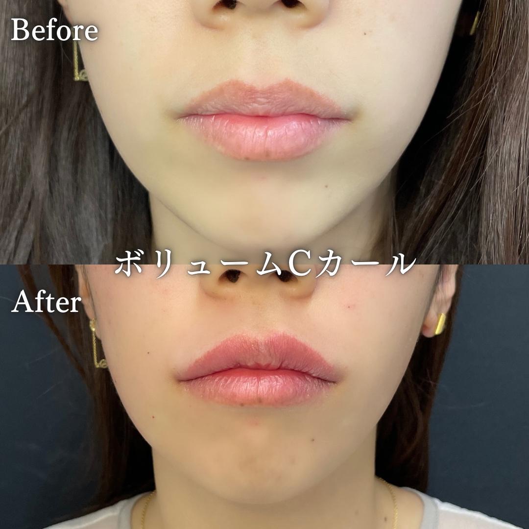 Cカールリップの症例写真