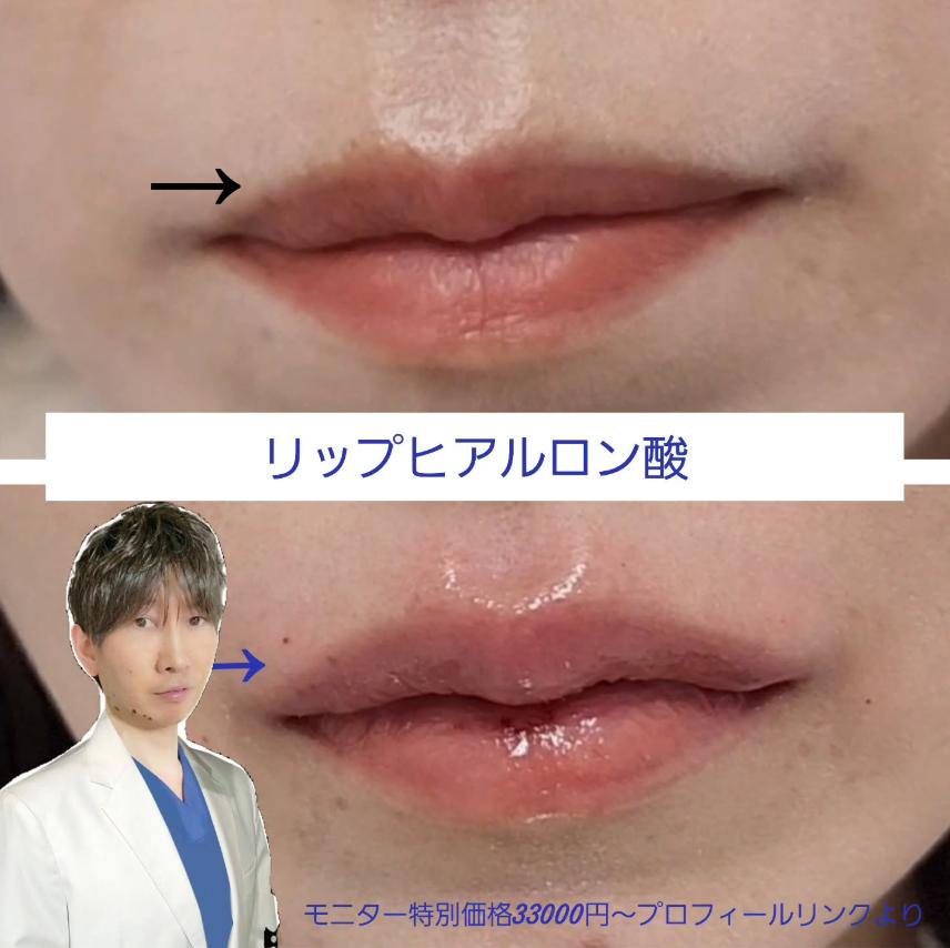 Cカールリップの症例写真