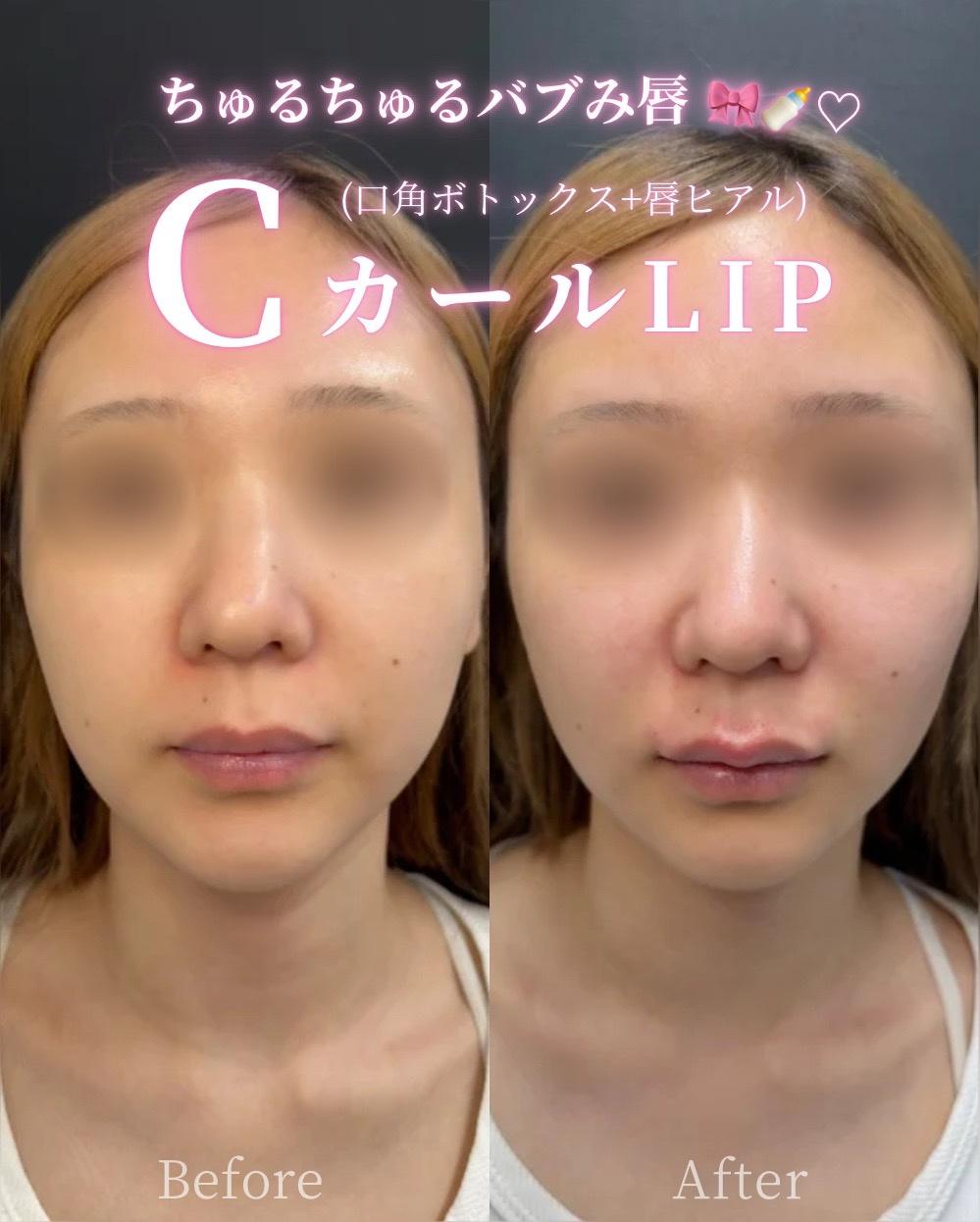 Cカールリップの症例写真