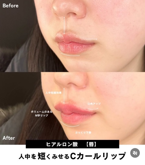 Cカールリップの症例写真