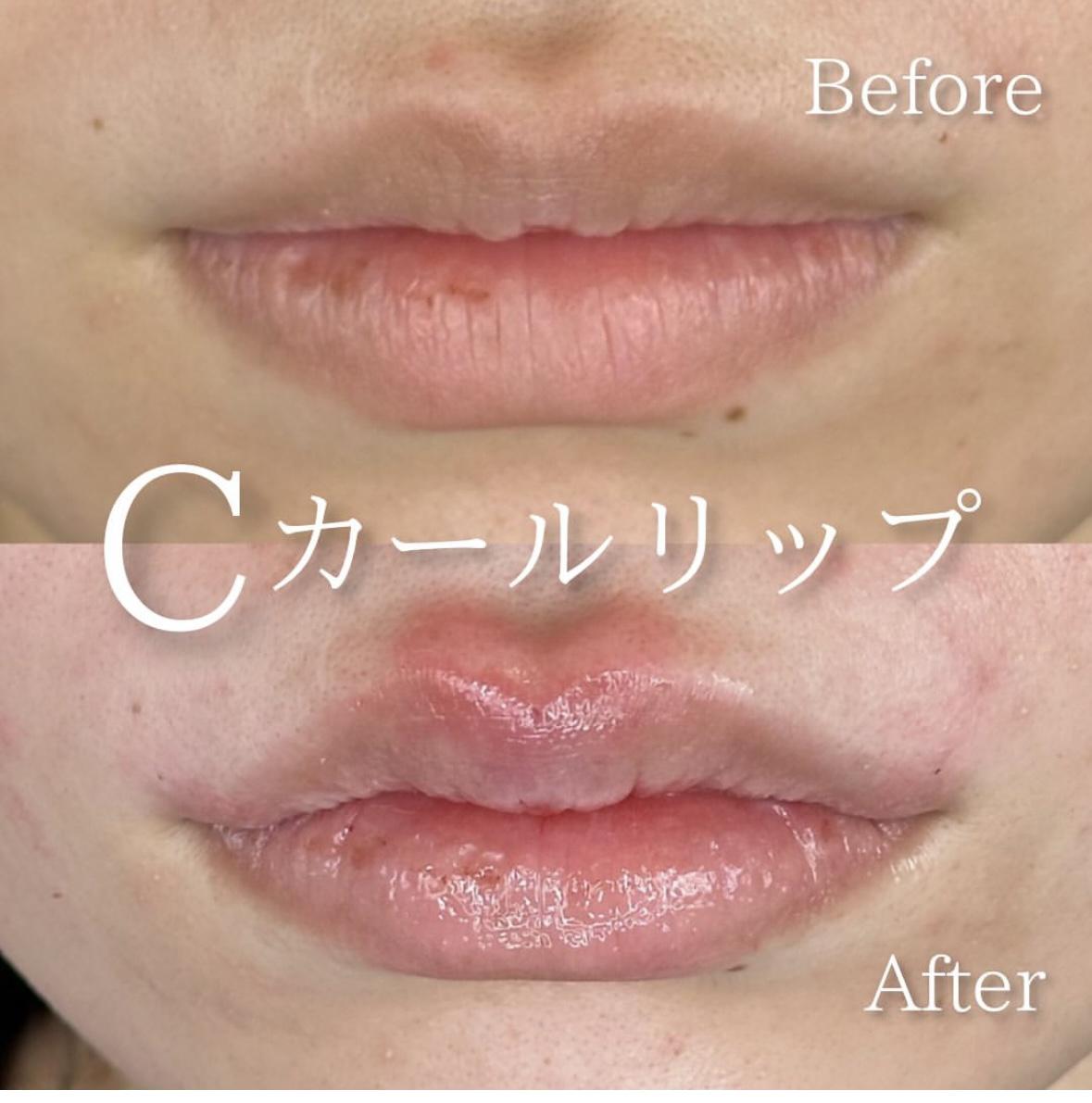 Cカールリップの症例写真