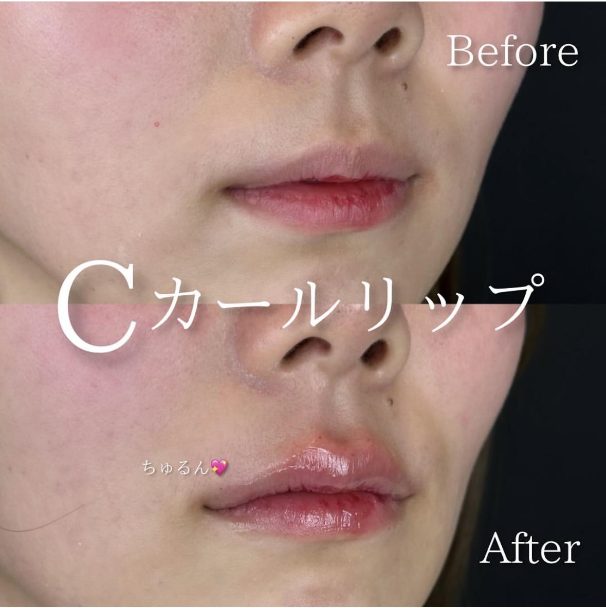 Cカールリップの症例写真