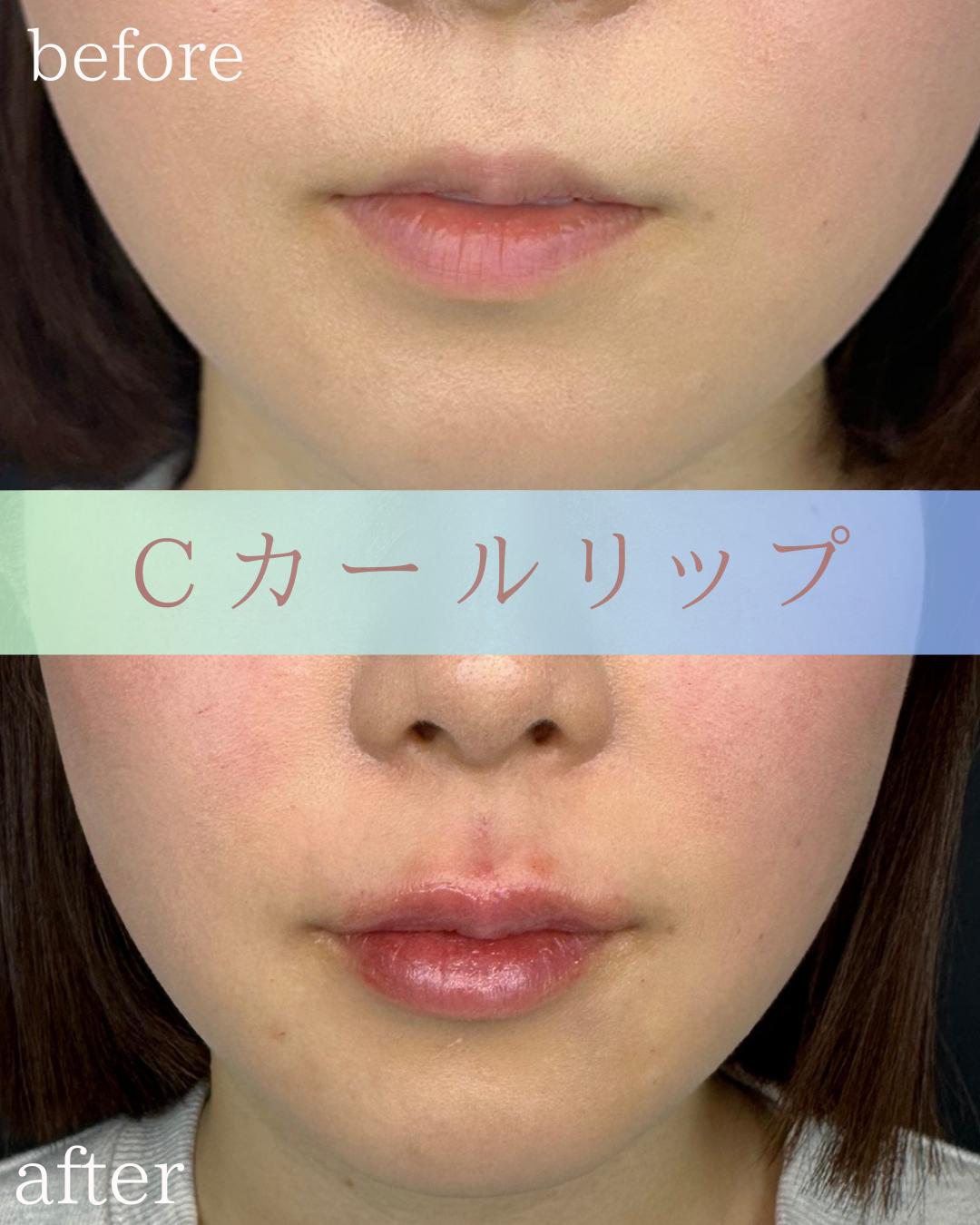 Cカールリップの症例写真