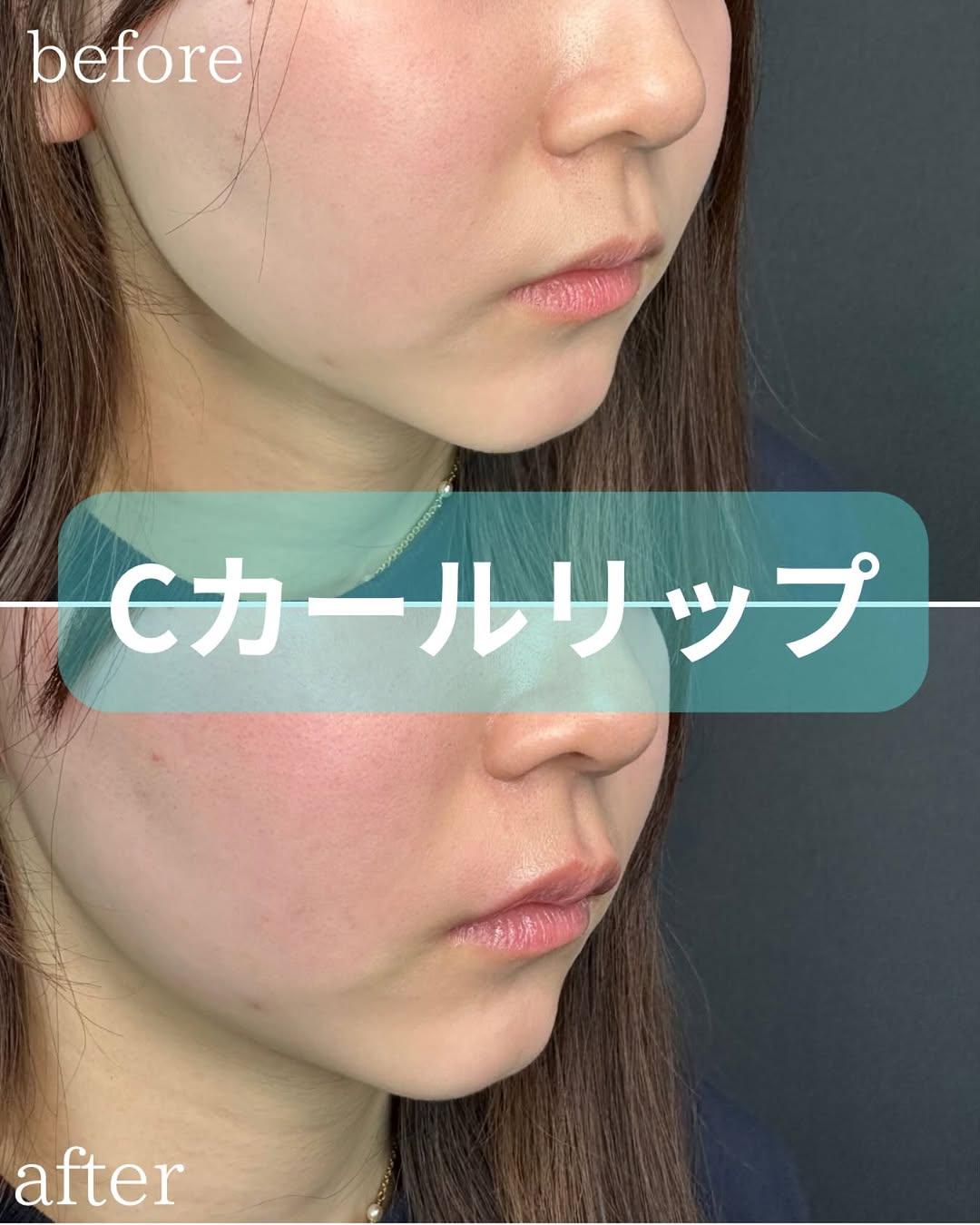 Cカールリップの症例写真