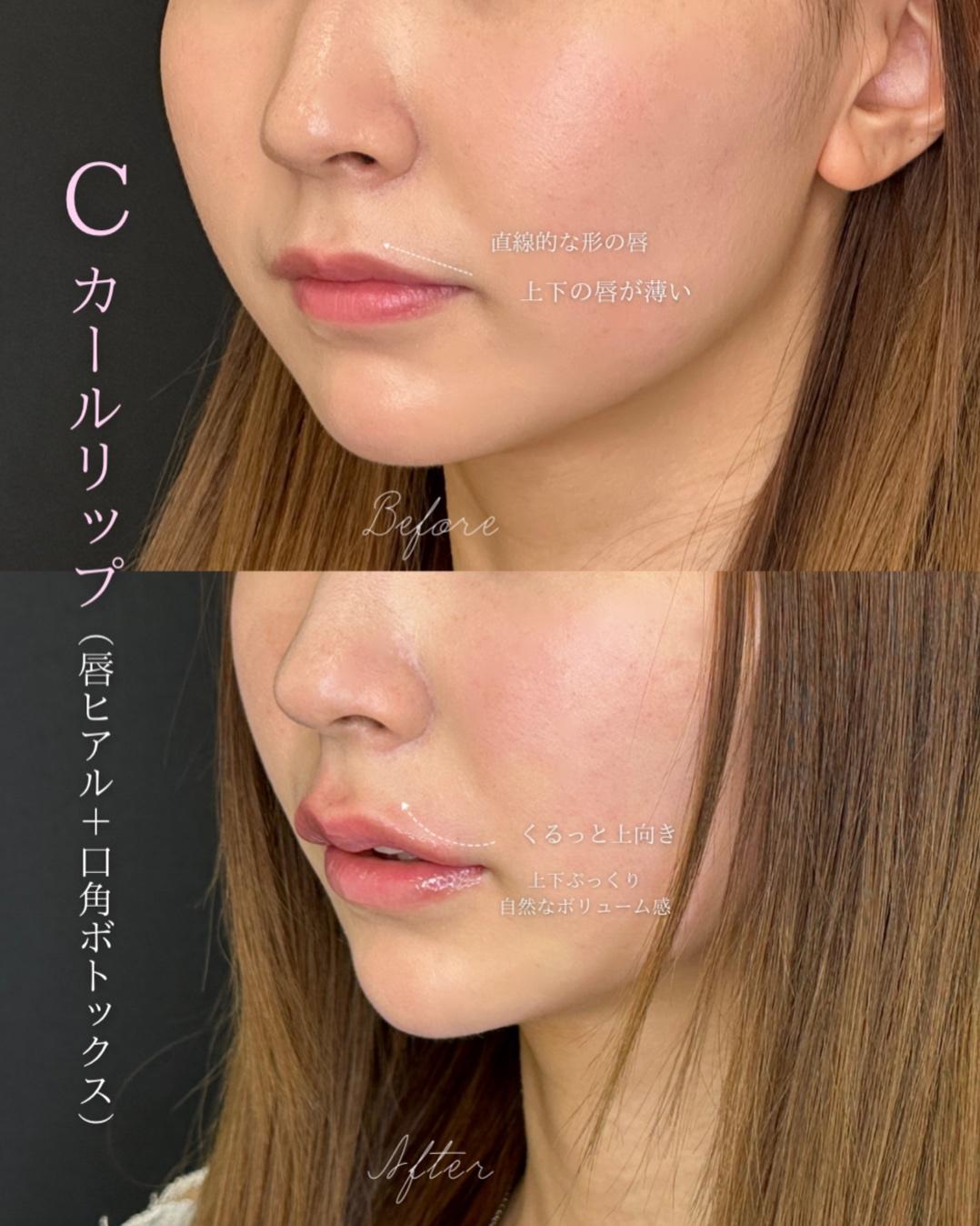 Cカールリップの症例写真