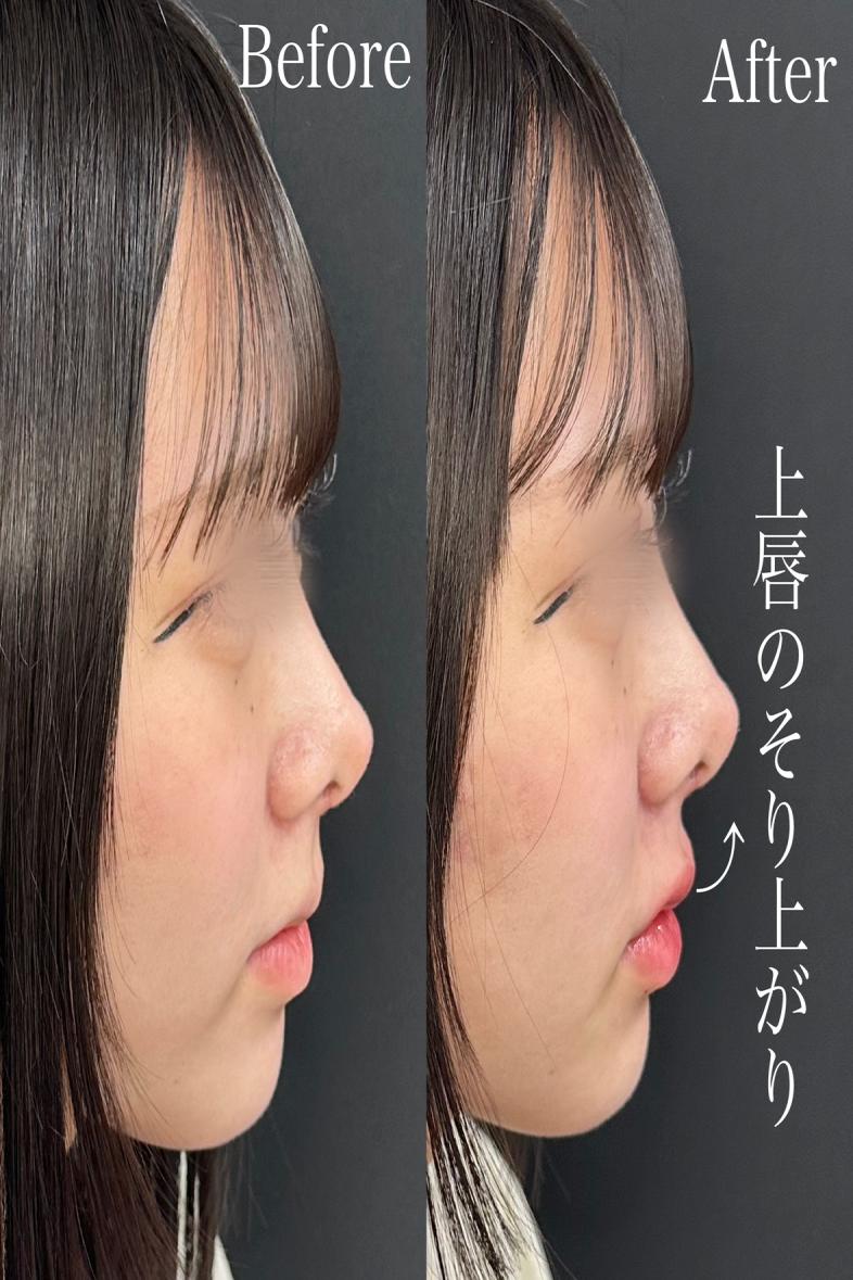 Cカールリップの症例写真