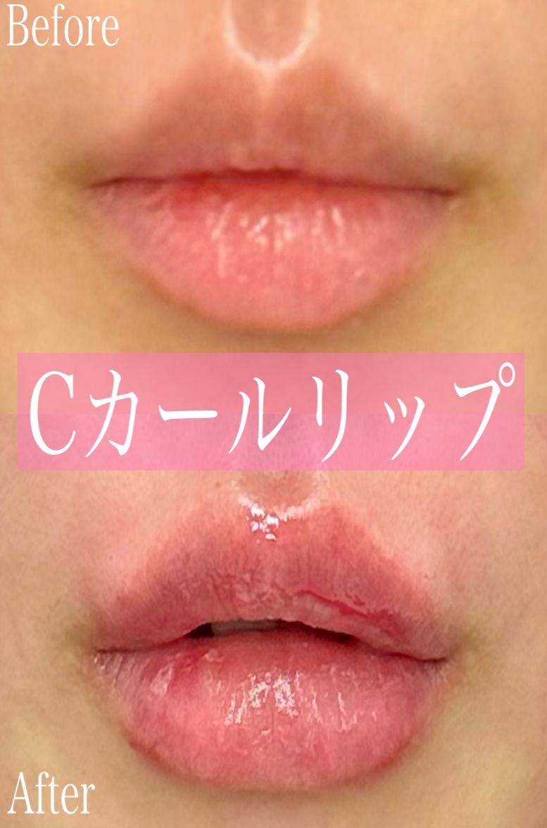 Cカールリップの症例写真