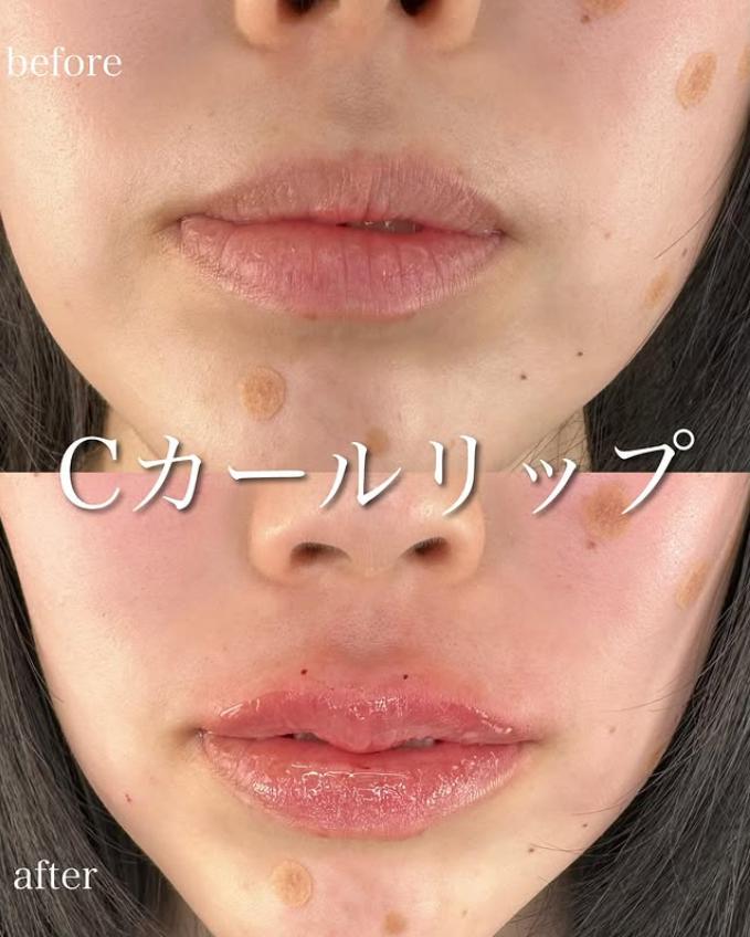 Cカールリップの症例写真