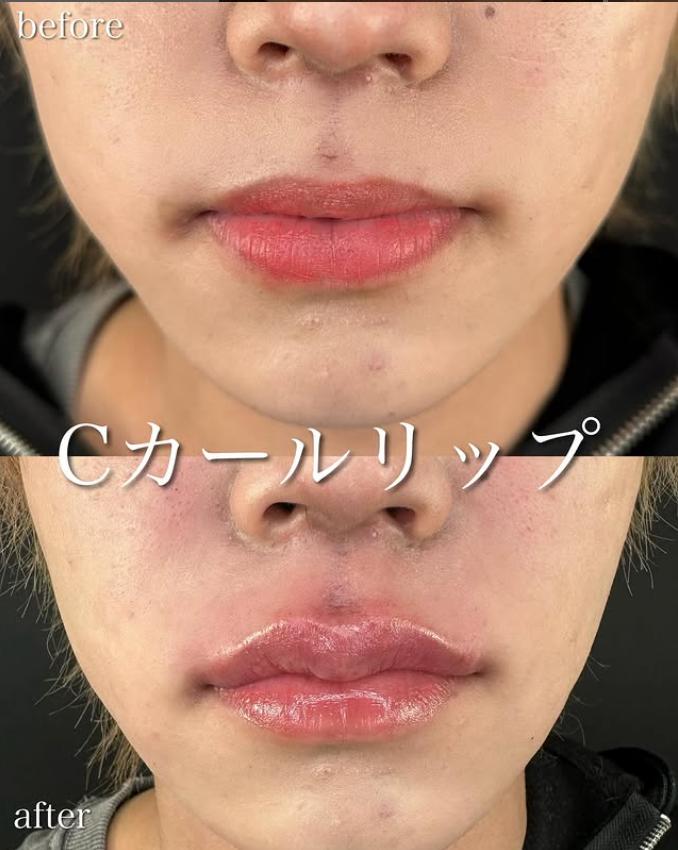 Cカールリップの症例写真