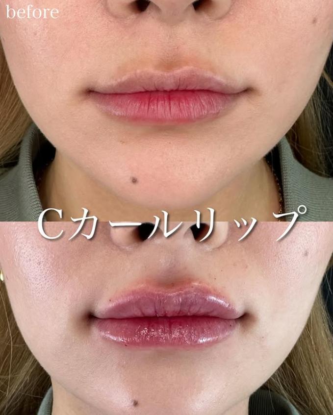 Cカールリップの症例写真