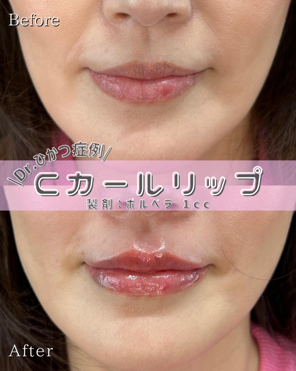 Cカールリップの症例写真
